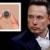 Elon Musk's brain chip implanted in first human