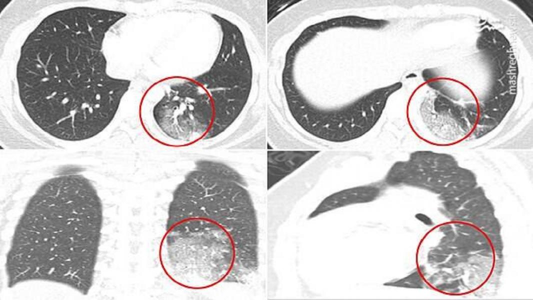 کشف روشی سریع برای تشخیص ابتلا به ویروس کرونا با سی تی اسکن
