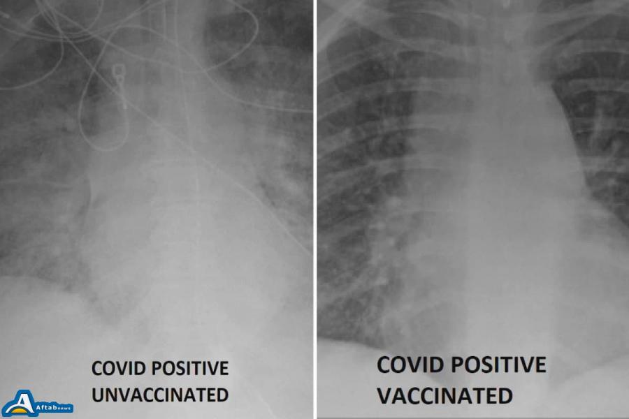 عکس| تفاوت ریه افرادی که واکسن کرونا زده‌اند با افرادی که واکسن نزده‌اند