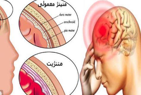 مننژیت چیست؟