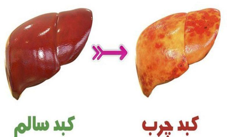 علائم کبد چرب در زنان چیست؟