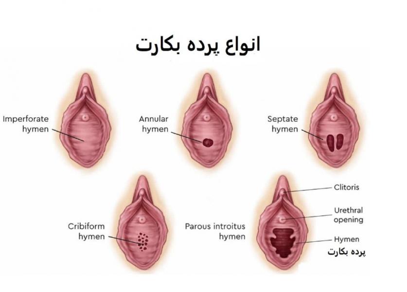 تاریخ ساختگی هزاران ساله پرده بکارت