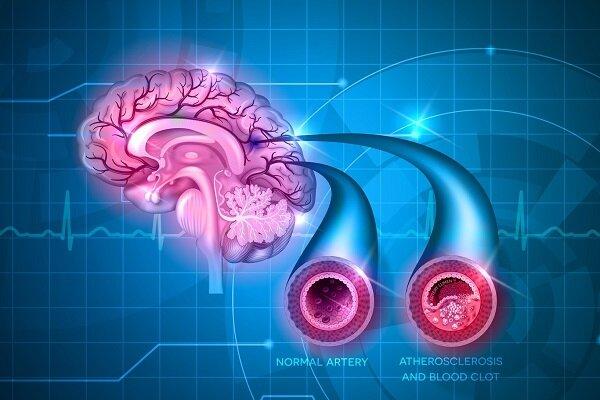 داروهای ضدتهوع ریسک سکته مغزی را افزایش می دهند