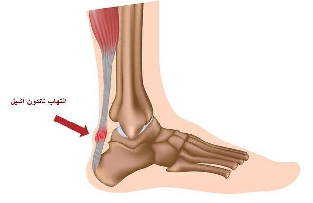 تاندونیت آشیل چیست؟