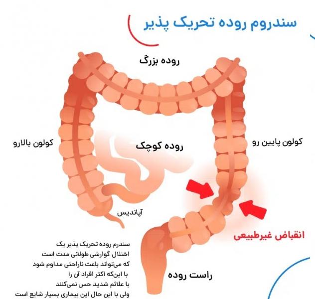 سندرم روده تحریک پذیر؛ خطرناک اما بی سر و صدا