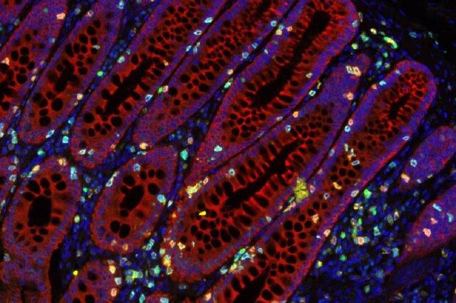 کشف نقشه‌ی راه برای غلبه بر سرطان روده